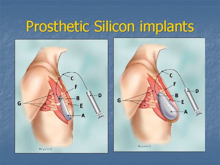 Prosthetic Silicon implants 
