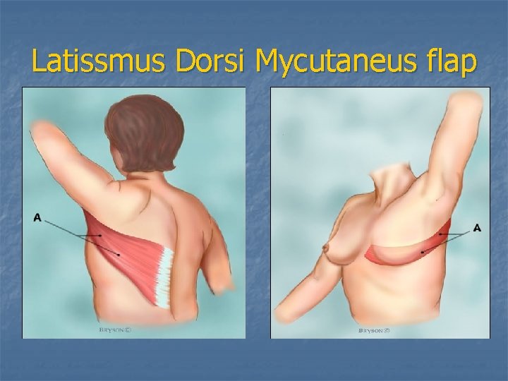 Latissmus Dorsi Mycutaneus flap 