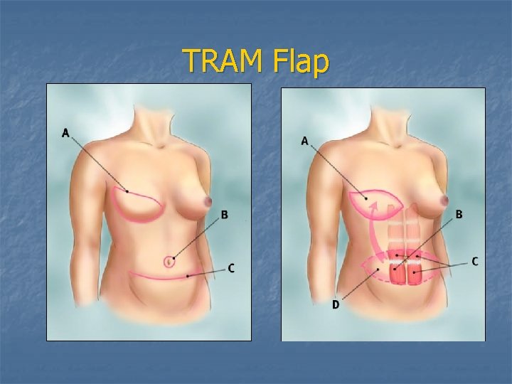 TRAM Flap 