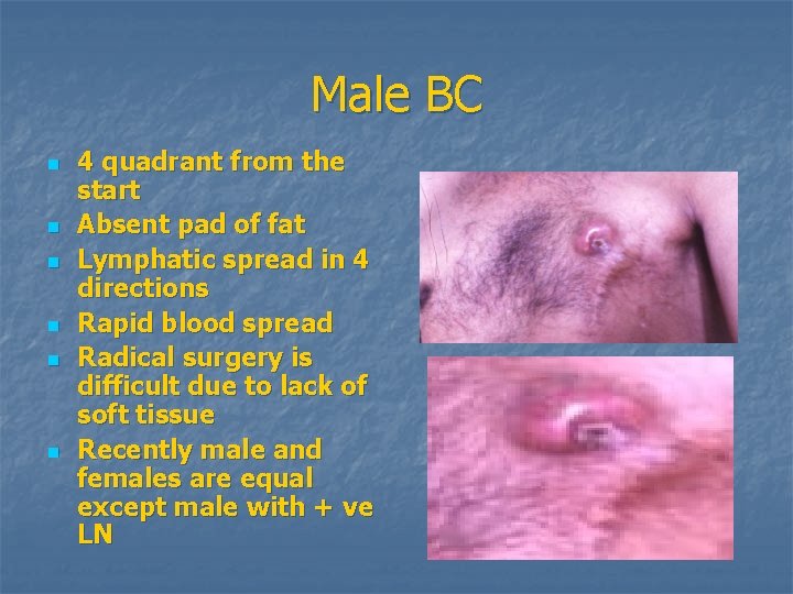 Male BC n n n 4 quadrant from the start Absent pad of fat