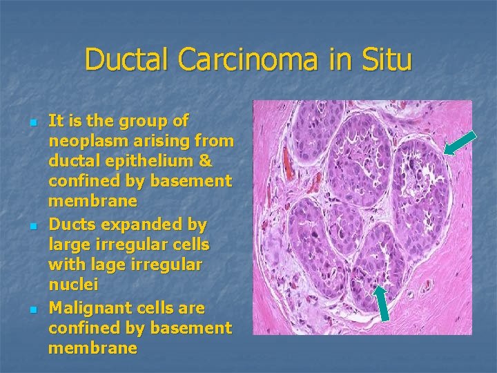Ductal Carcinoma in Situ n n n It is the group of neoplasm arising