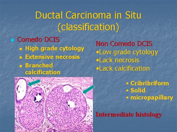 Ductal Carcinoma in Situ (classification) n Comedo DCIS n n n High grade cytology