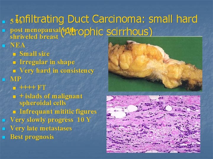 n n n n Duct Carcinoma: small 5 Infiltrating % post menopausal(Atrophic with scirrhous