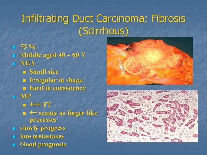 Infiltrating Duct Carcinoma: Fibrosis (Scirrhous) n n n n 75 % Middle aged 40