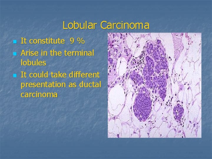 Lobular Carcinoma n n n It constitute 9 % Arise in the terminal lobules