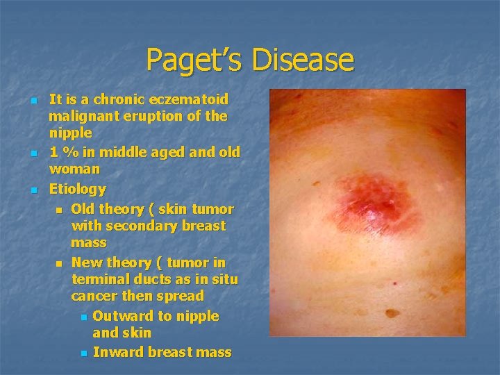 Paget’s Disease n n n It is a chronic eczematoid malignant eruption of the