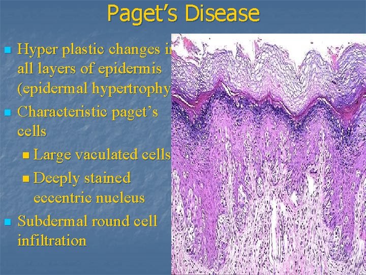 Paget’s Disease n n n Hyper plastic changes in all layers of epidermis (epidermal