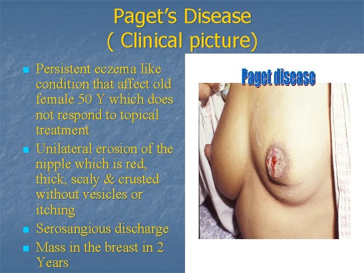 Paget’s Disease ( Clinical picture) n n Persistent eczema like condition that affect old