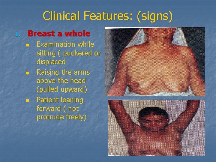 Clinical Features: (signs) 1. Breast a whole n n n Examination while sitting (