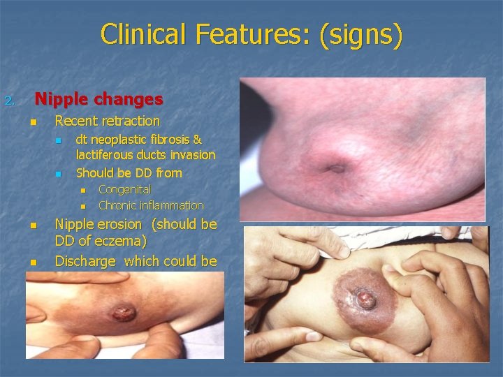 Clinical Features: (signs) 2. Nipple changes n Recent retraction n n dt neoplastic fibrosis