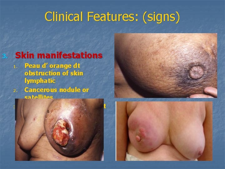 Clinical Features: (signs) 3. Skin manifestations 1. 2. 3. Peau d’ orange dt obstruction