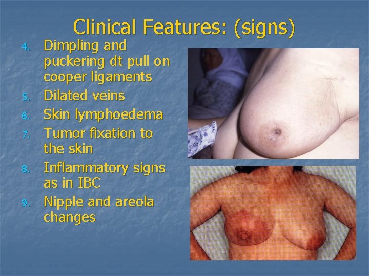 Clinical Features: (signs) 4. 5. 6. 7. 8. 9. Dimpling and puckering dt pull