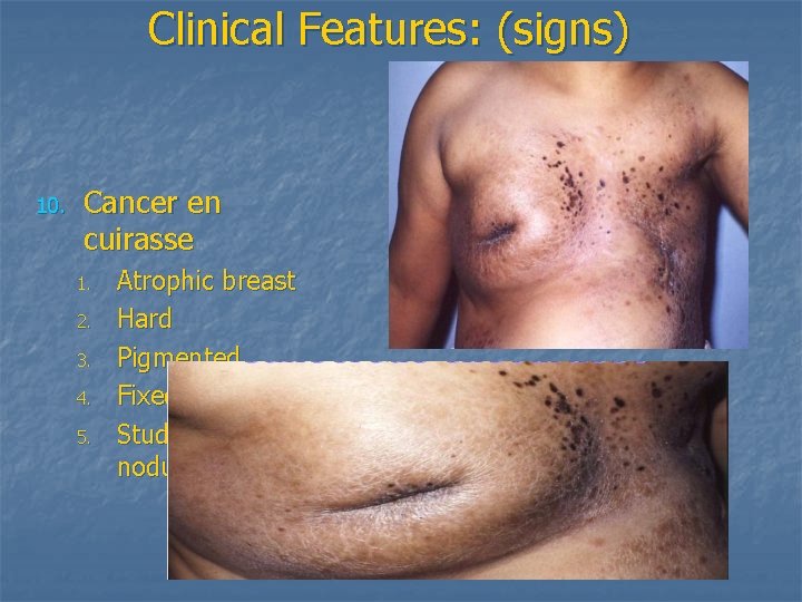 Clinical Features: (signs) 10. Cancer en cuirasse 1. 2. 3. 4. 5. Atrophic breast