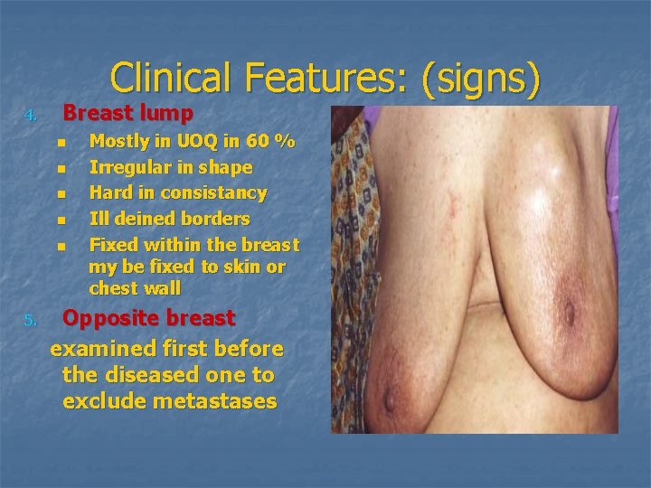 Clinical Features: (signs) 4. Breast lump n n n 5. Mostly in UOQ in