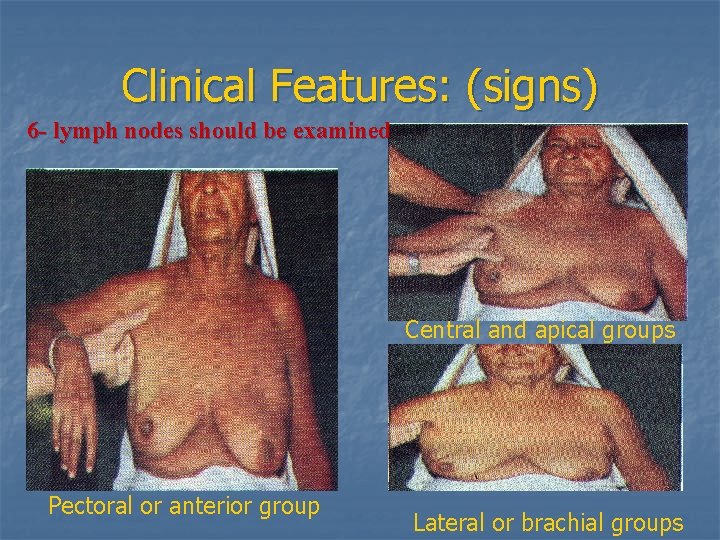 Clinical Features: (signs) 6 - lymph nodes should be examined Central and apical groups