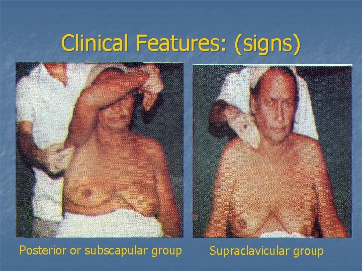 Clinical Features: (signs) Posterior or subscapular group Supraclavicular group 