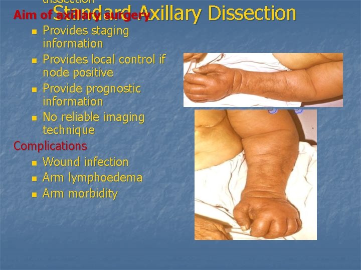 dissection Aim of axillary surgery n Provides staging information n Provides local control if