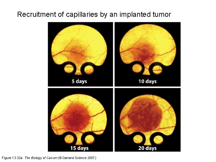 Recruitment of capillaries by an implanted tumor Figure 13. 32 a The Biology of