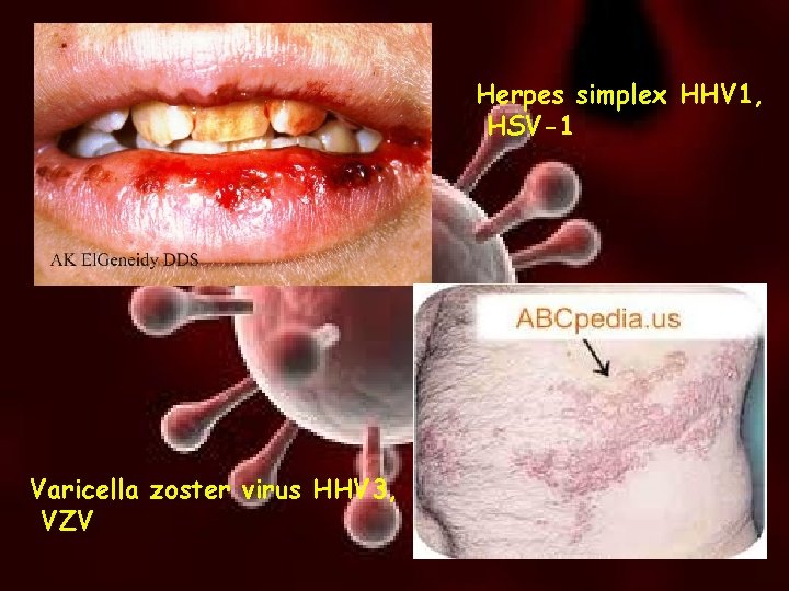 Herpes simplex HHV 1, HSV-1 Varicella zoster virus HHV 3, VZV 