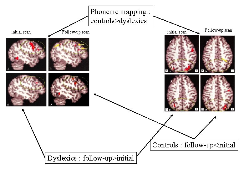 Phoneme mapping : controls>dyslexics initial scan Follow-up scan Controls : follow-up<initial Dyslexics : follow-up>initial