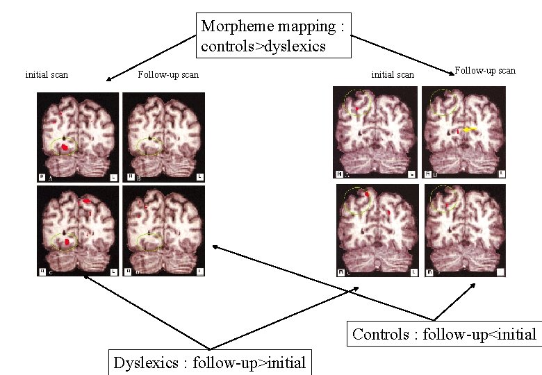 Morpheme mapping : controls>dyslexics initial scan Follow-up scan Controls : follow-up<initial Dyslexics : follow-up>initial