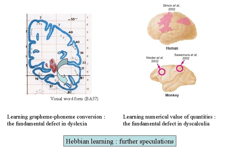 Visual word form (BA 37) Learning grapheme-phoneme conversion : the fundamental defect in dyslexia