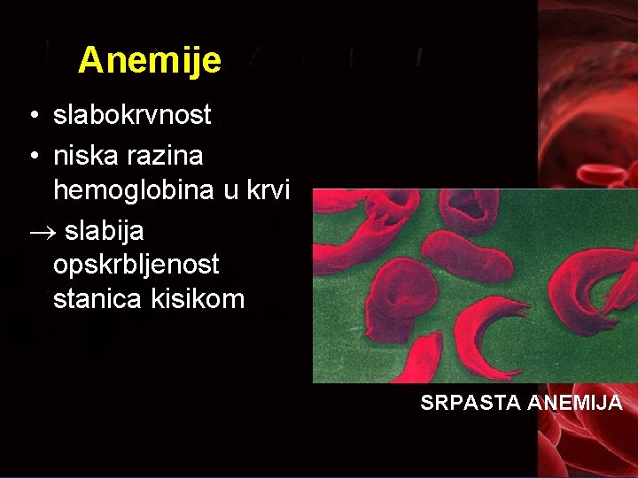 Anemije • slabokrvnost • niska razina hemoglobina u krvi slabija opskrbljenost stanica kisikom SRPASTA