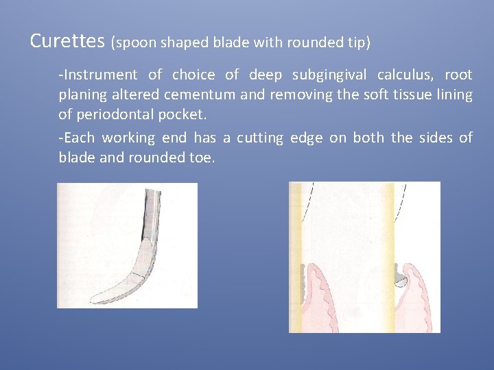 Curettes (spoon shaped blade with rounded tip) -Instrument of choice of deep subgingival calculus,