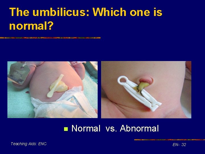 The umbilicus: Which one is normal? n Teaching Aids: ENC Normal vs. Abnormal EN-