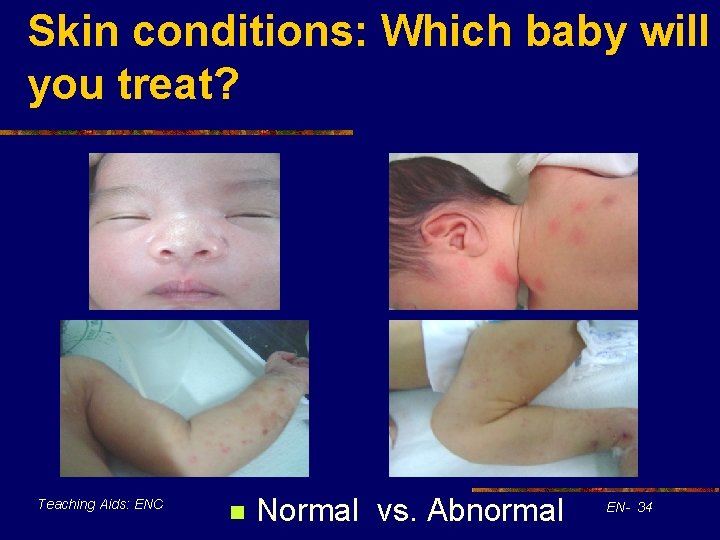 Skin conditions: Which baby will you treat? Teaching Aids: ENC n Normal vs. Abnormal