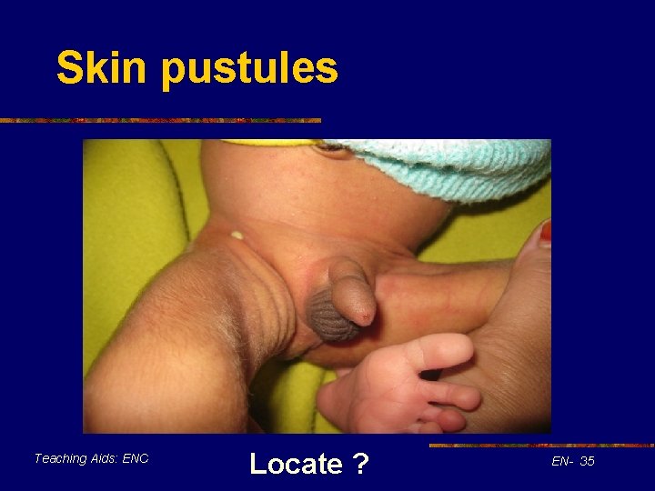 Skin pustules Teaching Aids: ENC Locate ? EN- 35 