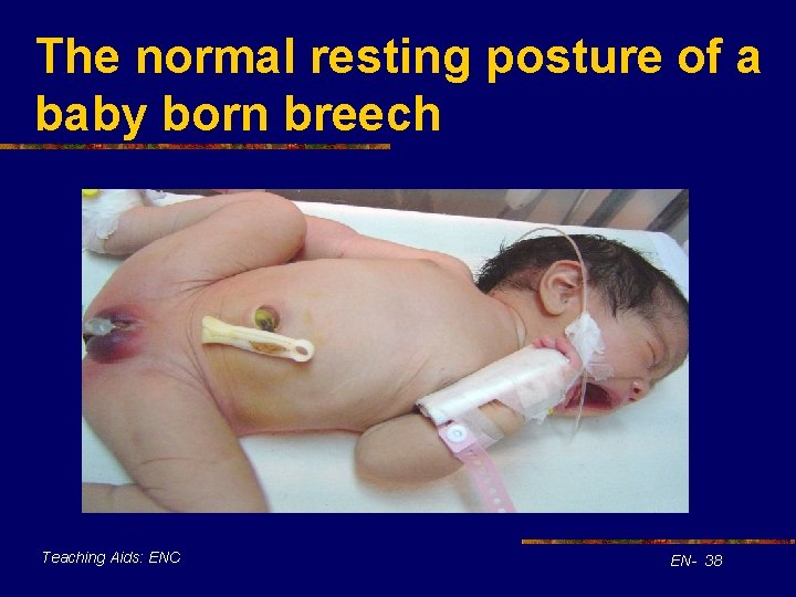 The normal resting posture of a baby born breech Teaching Aids: ENC EN- 38