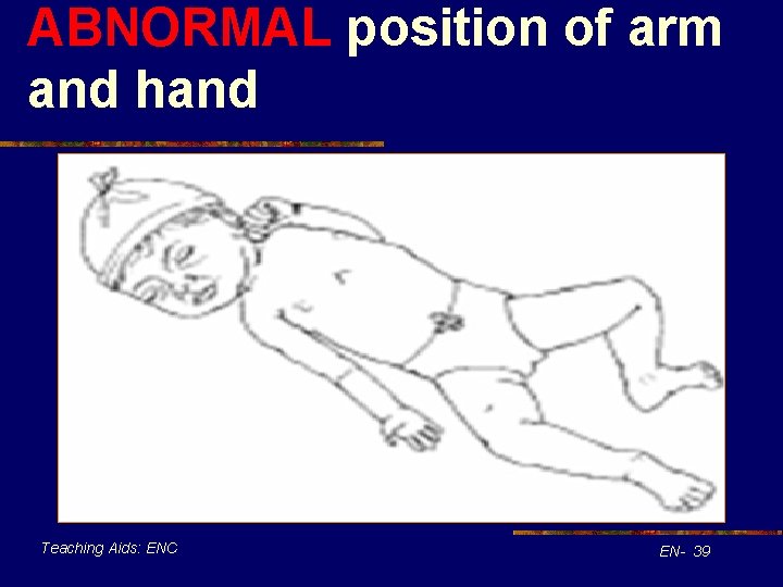 ABNORMAL position of arm and hand Teaching Aids: ENC EN- 39 