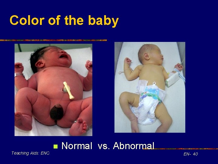 Color of the baby n Teaching Aids: ENC Normal vs. Abnormal EN- 40 