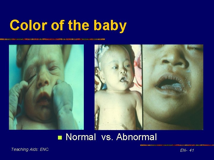 Color of the baby n Teaching Aids: ENC Normal vs. Abnormal EN- 41 