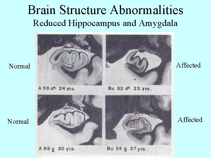 Brain Structure Abnormalities Reduced Hippocampus and Amygdala Normal Affected 