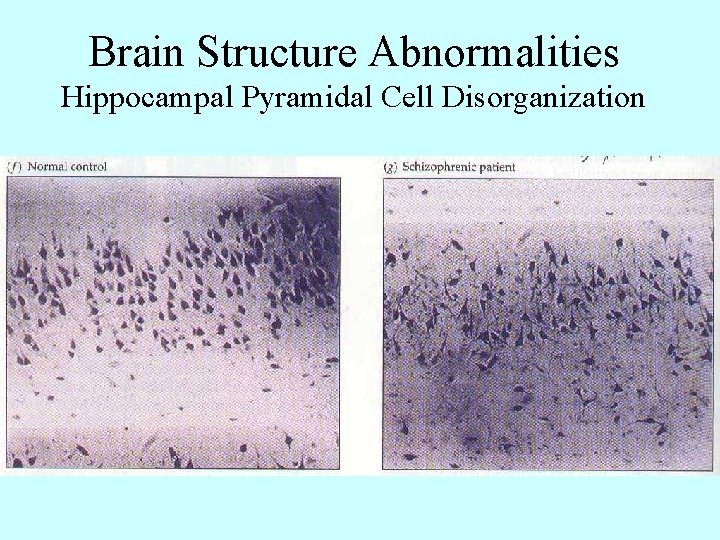 Brain Structure Abnormalities Hippocampal Pyramidal Cell Disorganization 