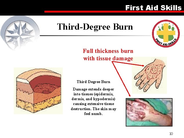 First Aid Skills Third-Degree Burn Full thickness burn with tissue damage Third Degree Burn