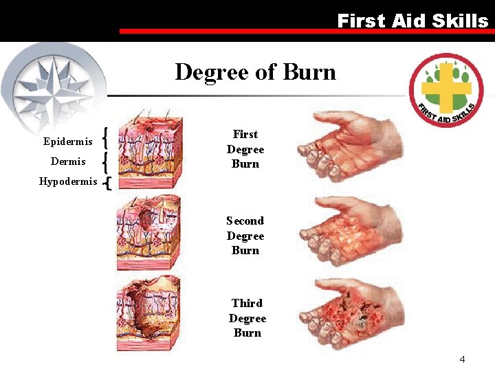 First Aid Skills Degree of Burn Epidermis Dermis First Degree Burn Hypodermis Second Degree