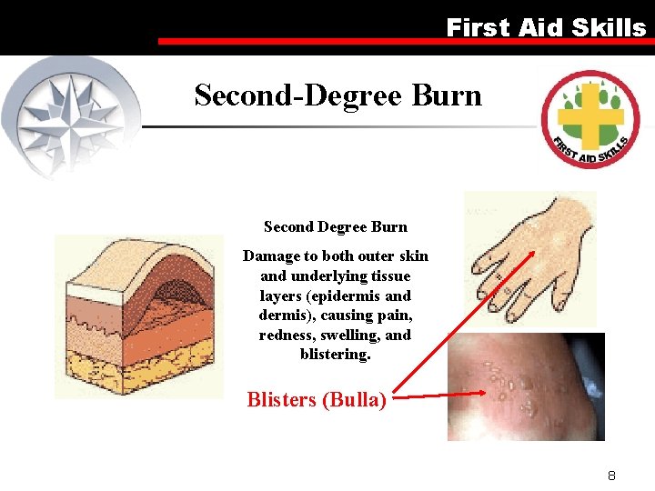 First Aid Skills Second-Degree Burn Second Degree Burn Damage to both outer skin and