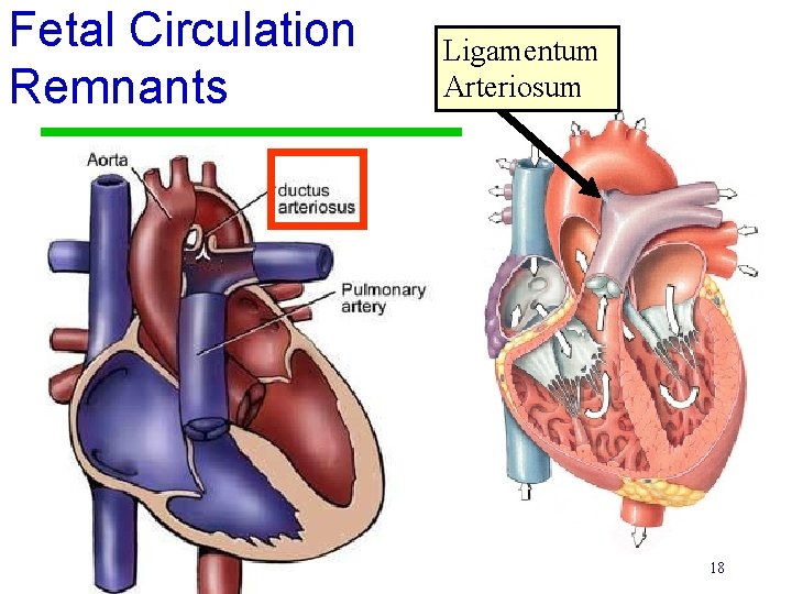 Fetal Circulation Remnants Ligamentum Arteriosum 18 Fetal Circulation Remnants Ligamentum Arteriosum 18