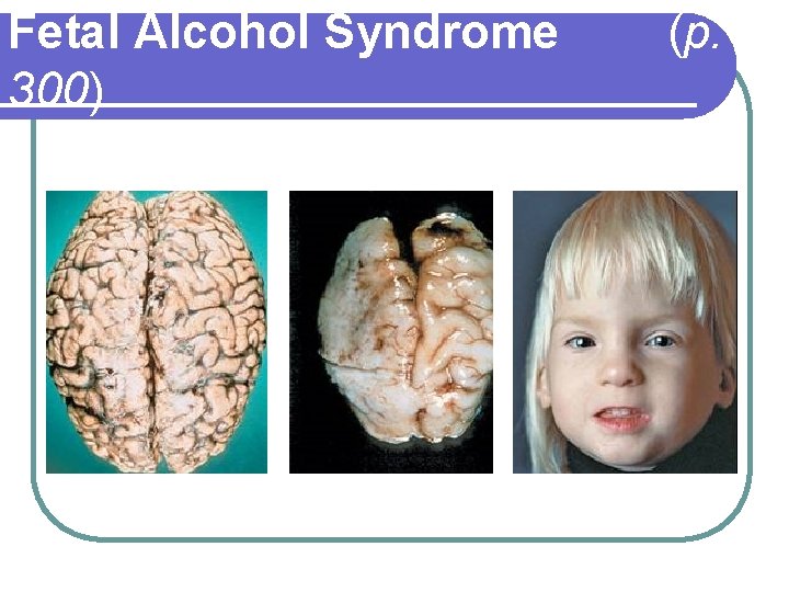 Fetal Alcohol Syndrome 300) (p. 