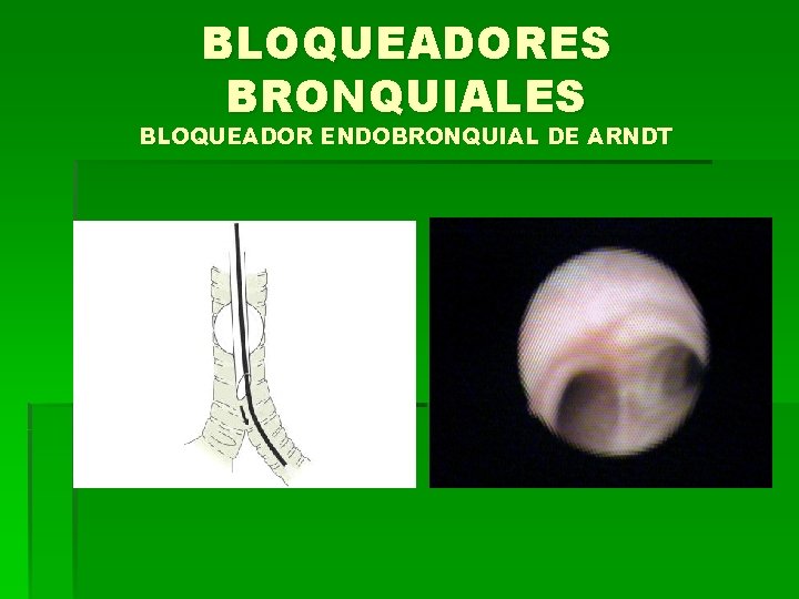 BLOQUEADORES BRONQUIALES BLOQUEADOR ENDOBRONQUIAL DE ARNDT 