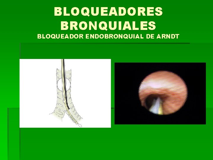 BLOQUEADORES BRONQUIALES BLOQUEADOR ENDOBRONQUIAL DE ARNDT 