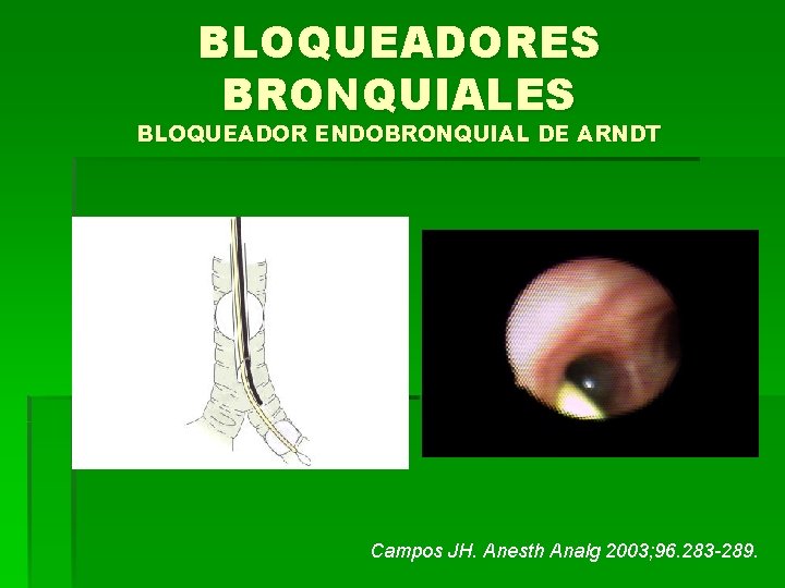 BLOQUEADORES BRONQUIALES BLOQUEADOR ENDOBRONQUIAL DE ARNDT Campos JH. Anesth Analg 2003; 96. 283 -289.