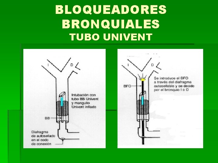 BLOQUEADORES BRONQUIALES TUBO UNIVENT 