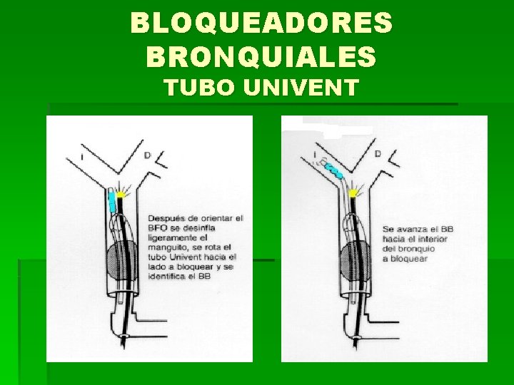 BLOQUEADORES BRONQUIALES TUBO UNIVENT 