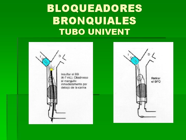 BLOQUEADORES BRONQUIALES TUBO UNIVENT 