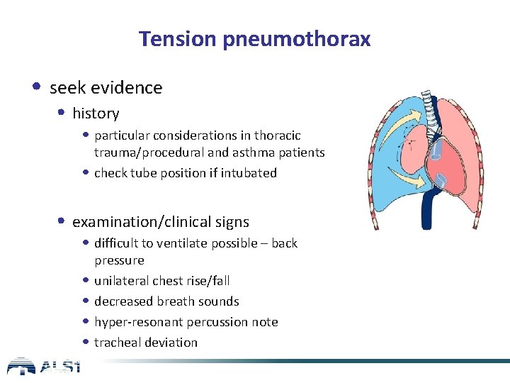 Tension pneumothorax • seek evidence • history • particular considerations in thoracic trauma/procedural and