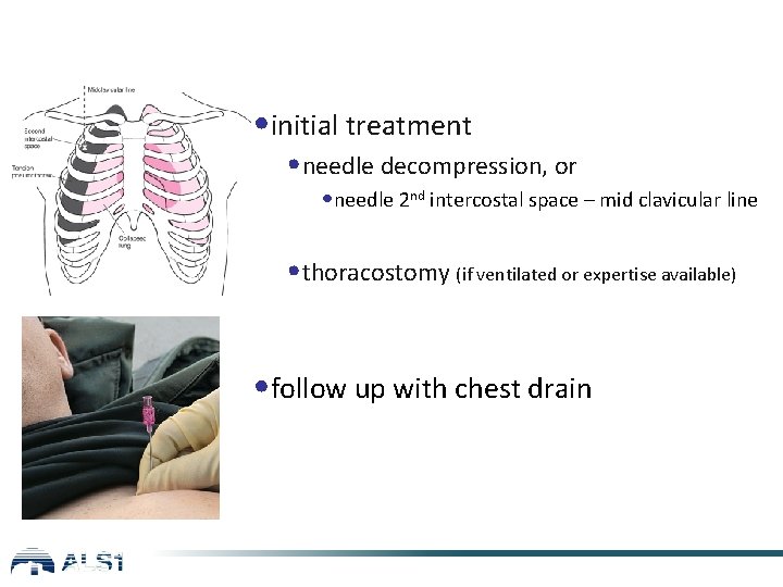  • initial treatment • needle decompression, or • needle 2 nd intercostal space
